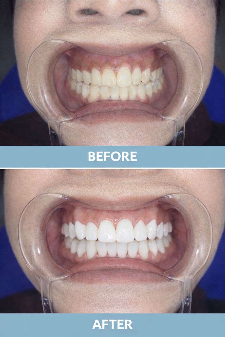 Before After Veneer